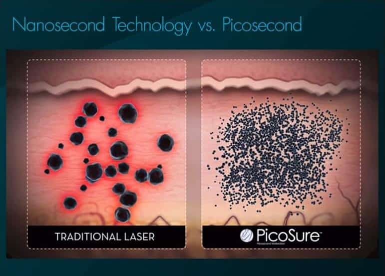 Nanosecond Technology vs. Picosecond
